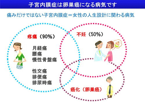 子宮内膜症は卵巣癌になる病気です